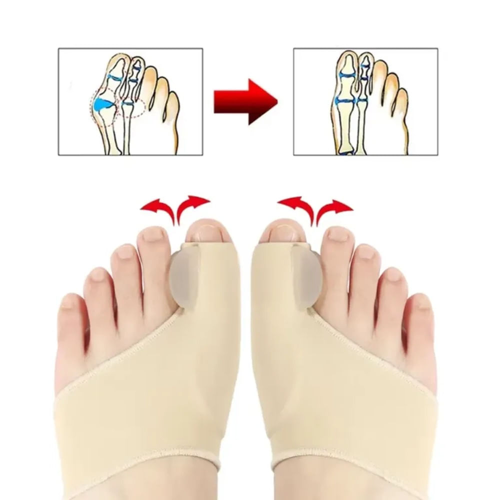 Corrector De Juanete Para Dedos De Los Pies
